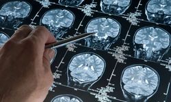 Alzheimer hastaları için gerçek bir tedavi sunan ilk ilaç: Lecanemab nedir?