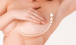 Meme Büyütme Ameliyatı Neden Tercih Edilir?