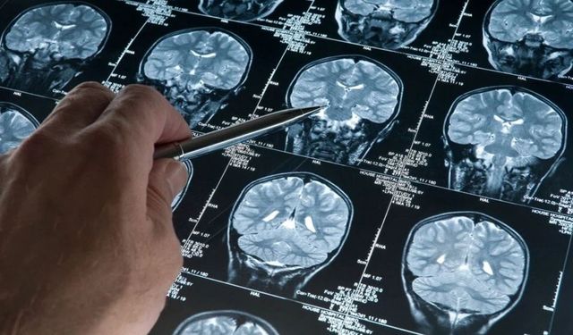 Alzheimer hastaları için gerçek bir tedavi sunan ilk ilaç: Lecanemab nedir?