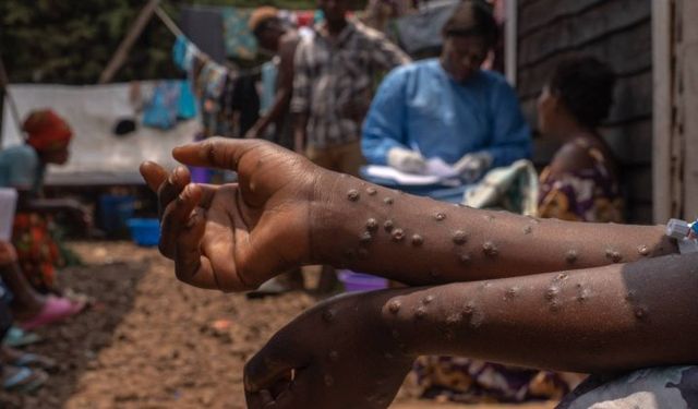 CDC: Maymun çiçeği salgını Afrika'da kontrolden çıktı