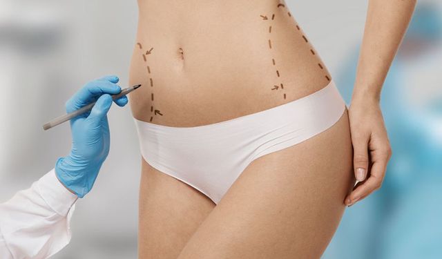 Liposuction: Bölgesel Yağlardan Kurtulmanın Etkili Yolu