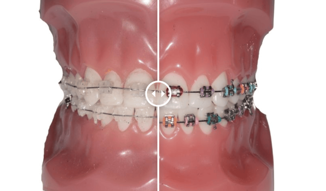 Estetik Gülüşler İçin Diş Teli Tedavisinde Yeni Nesil Yaklaşımlar