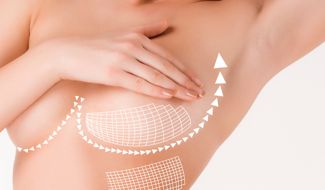 Meme Büyütme Ameliyatı Neden Tercih Edilir?